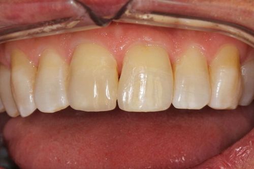 Teeth after dental bonding