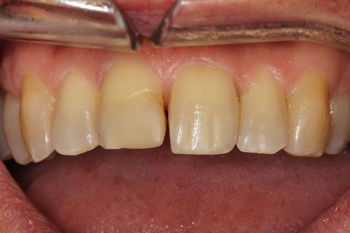 Teeth before dental bonding