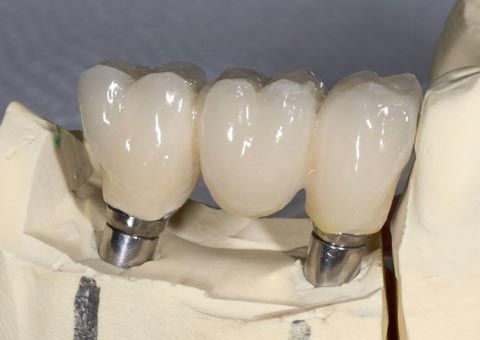 dental bridge