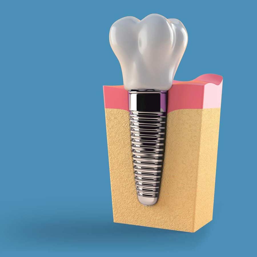 Dental implants