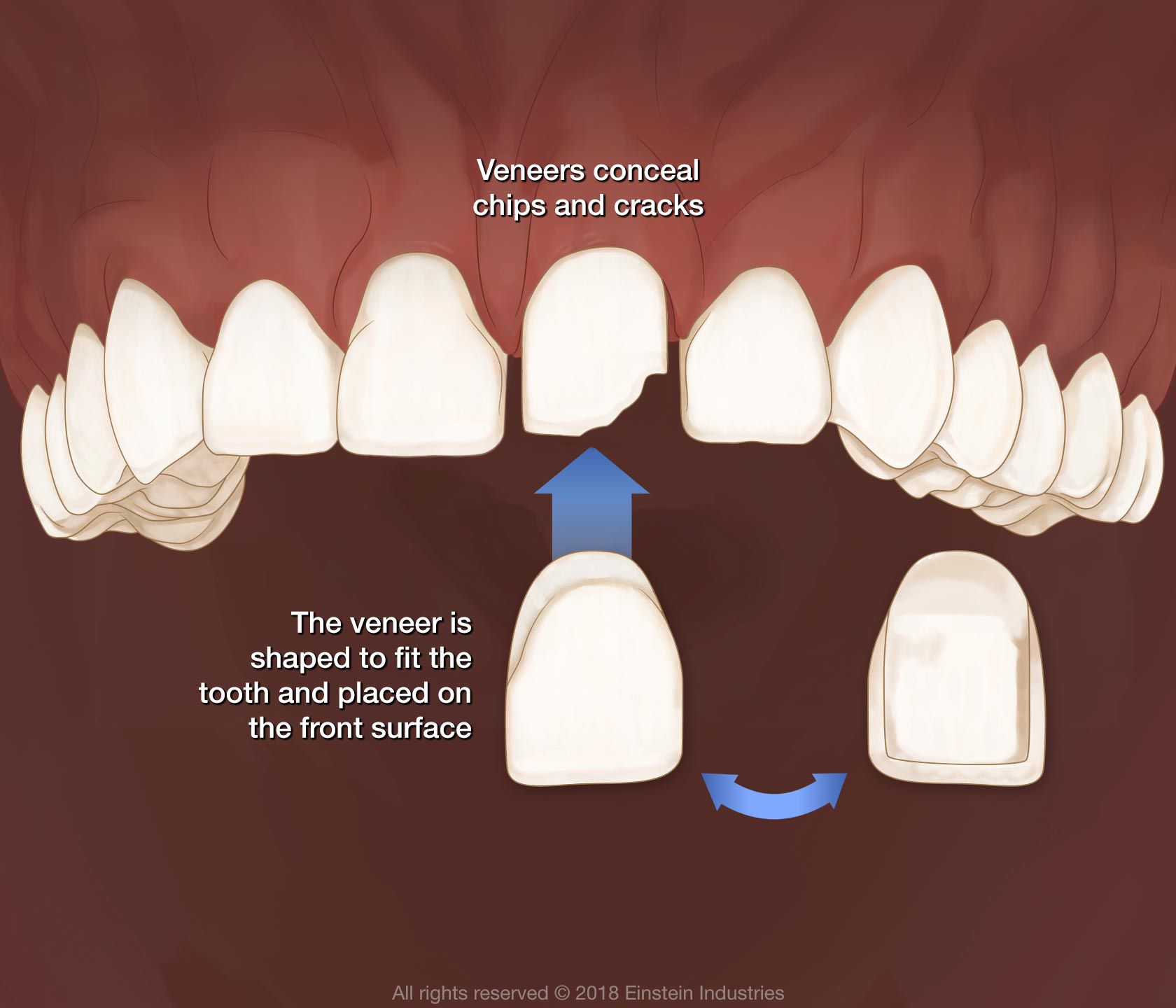 Illustration of veneer placement