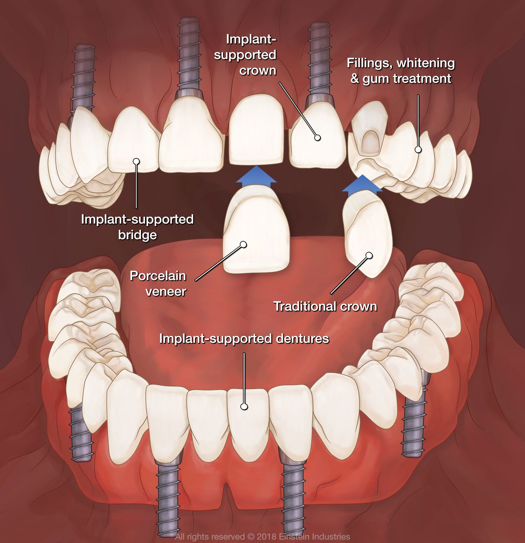 Diagram of full mouth reconstruction options