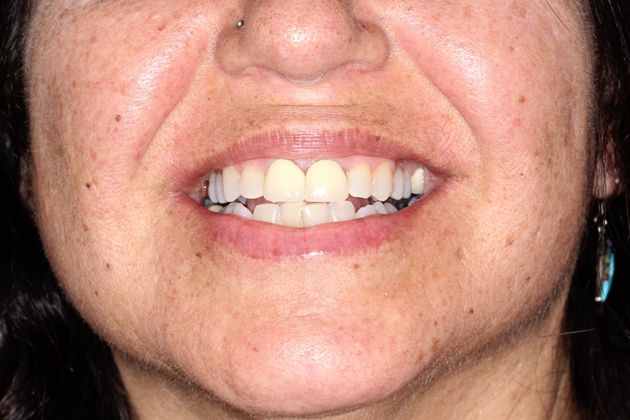 before dental implants